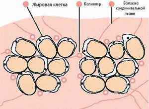 Целюлит, алоэ, алое вера, лечение целюлита